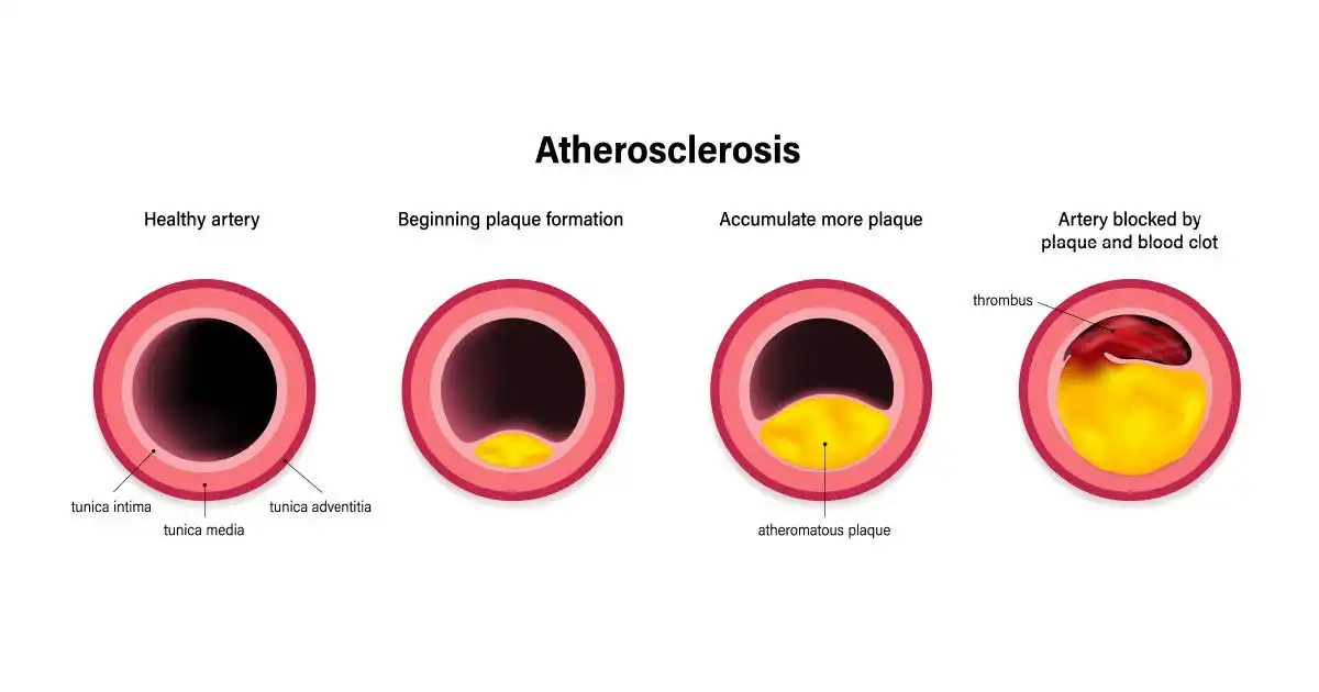 Peripheral Artery Disease Treatment in Mohali