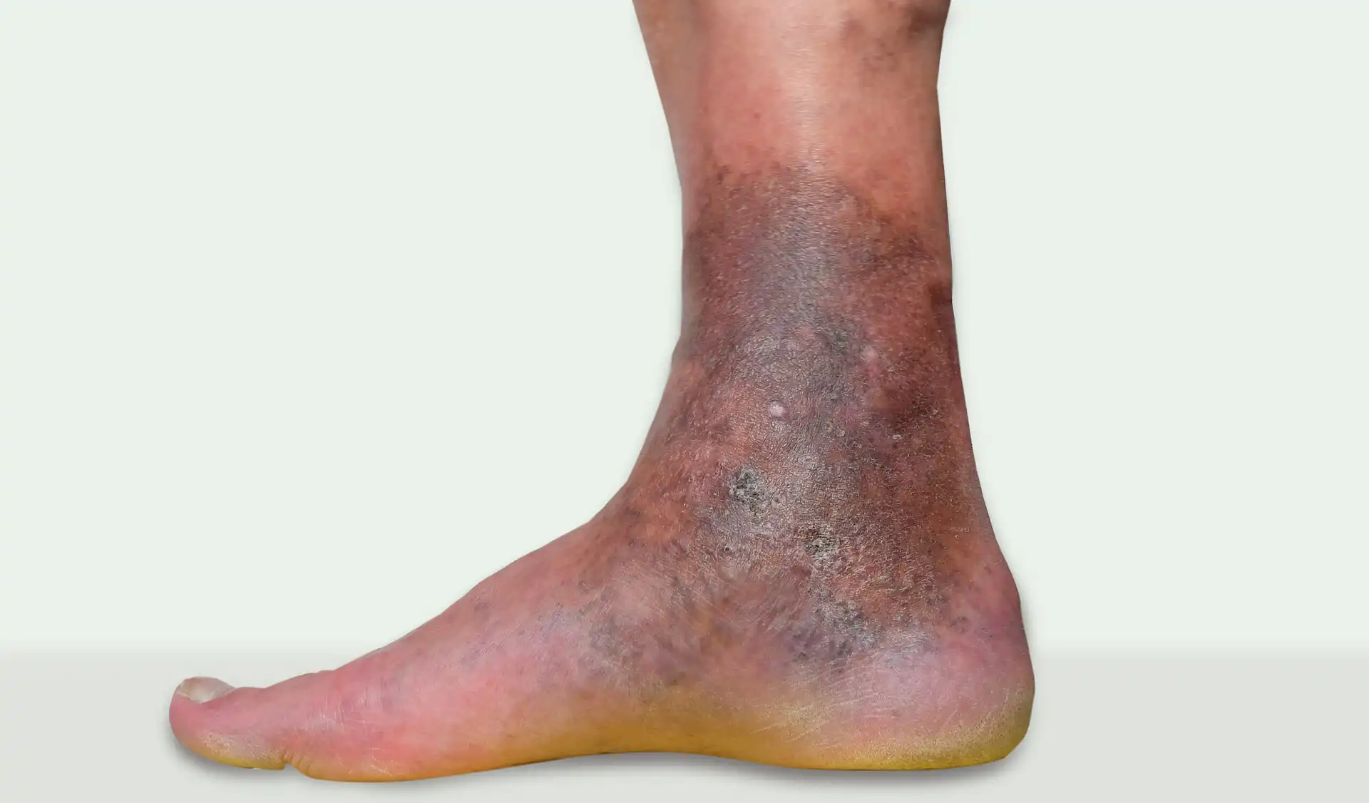 Venous Ulcer Treatment in Mohali - Expert Vascular Care
