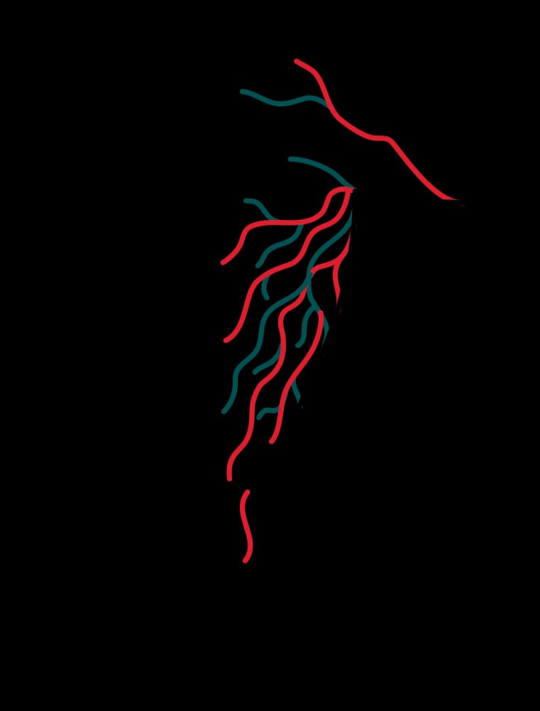 VARICOSE VEINS