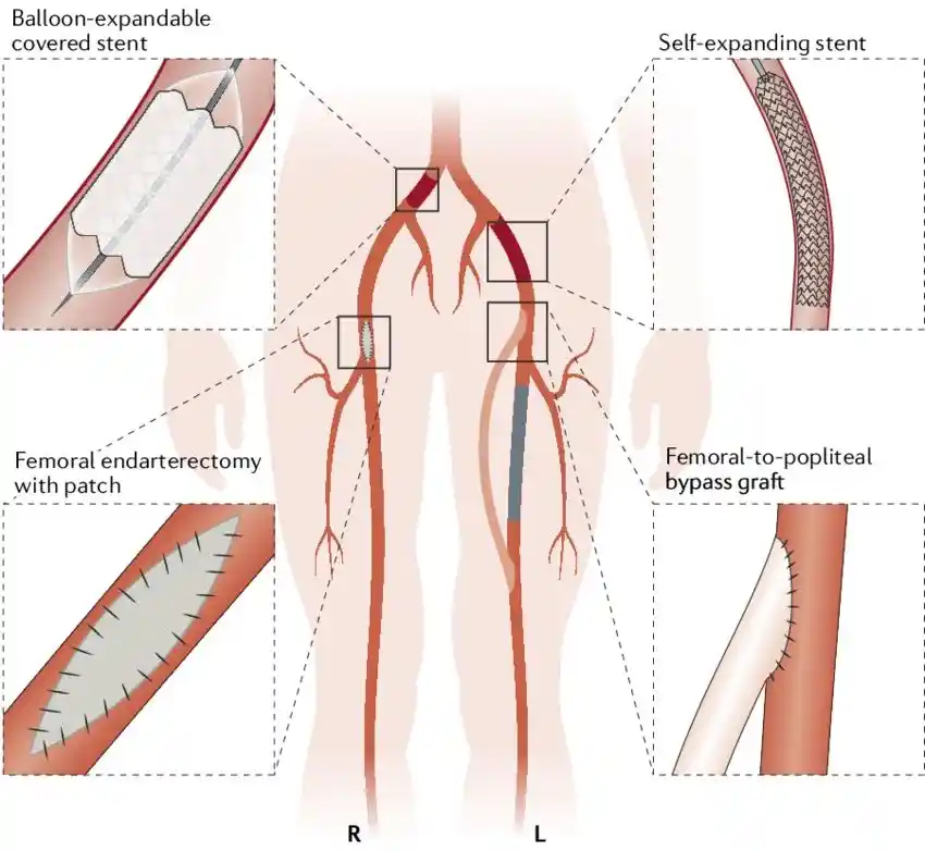 Hybrid Revascularization