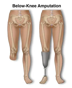 What Is Amputation Surgery ?