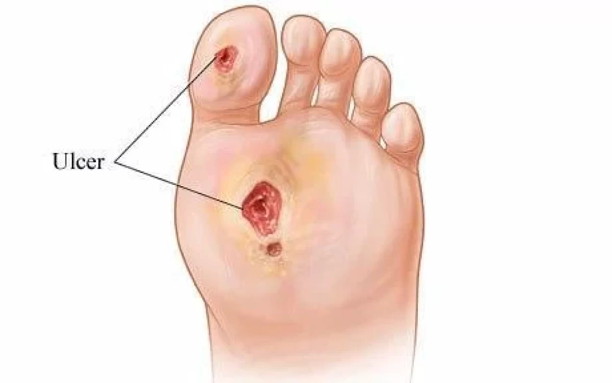 Revascularization