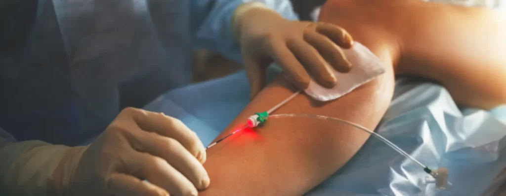 Laser Ablation (EVLT)